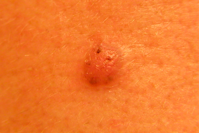 Базальный рак кожи