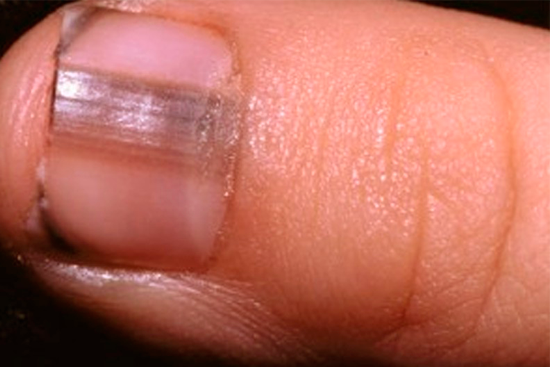 Меланома ногтя
