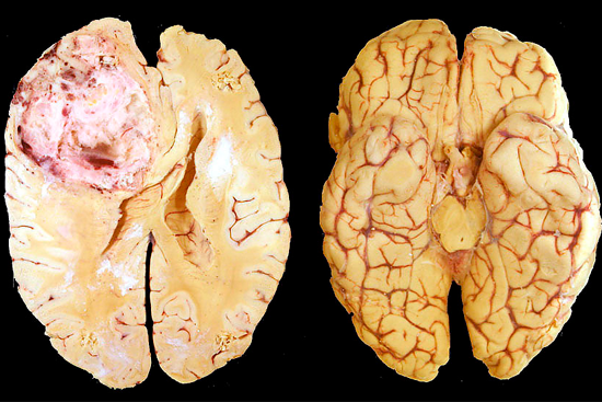 Опухоль головного мозга