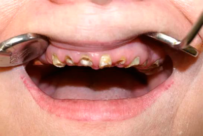 Чем может обернуться выпадение зубов