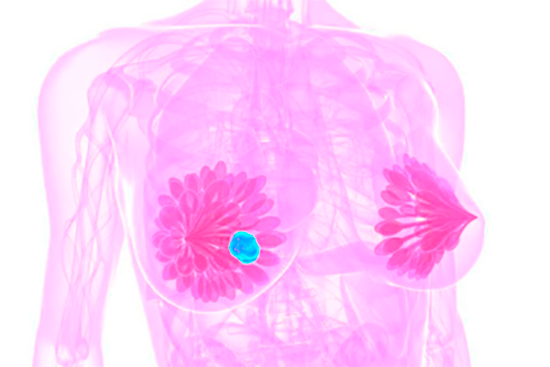 Рак груди с метастазами в лимфоузлах