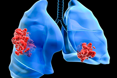 Лечение онкологии органов дыхания