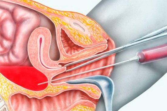 Лапароцентез: значение процедуры в диагностике и лечении патологий брюшной полости