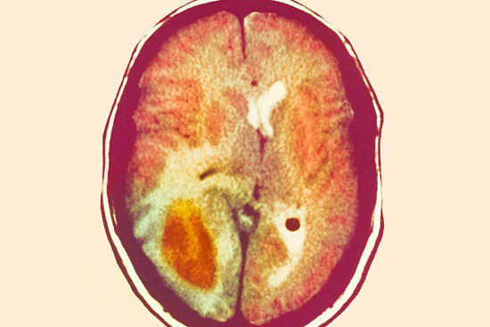 Глиома: к чему приводит опухоль мозга?