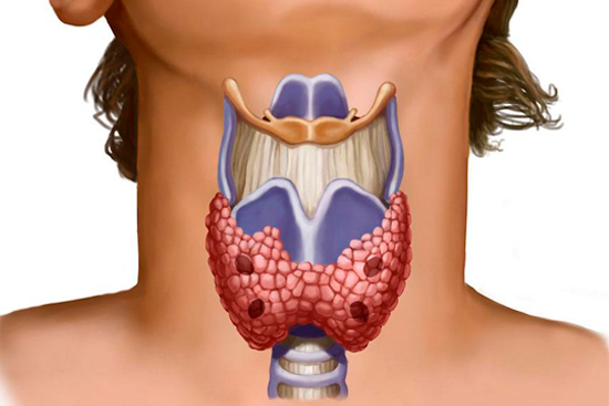 Карцинома щитовидной железы