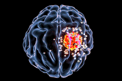 Раковые клетки в головном мозгу